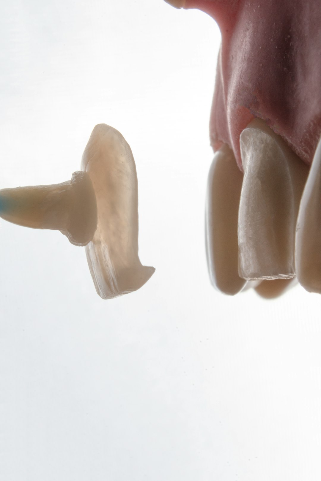 Implant Supported Dentures